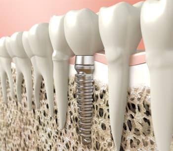 Dental implant treatment at Shine Dental Newington