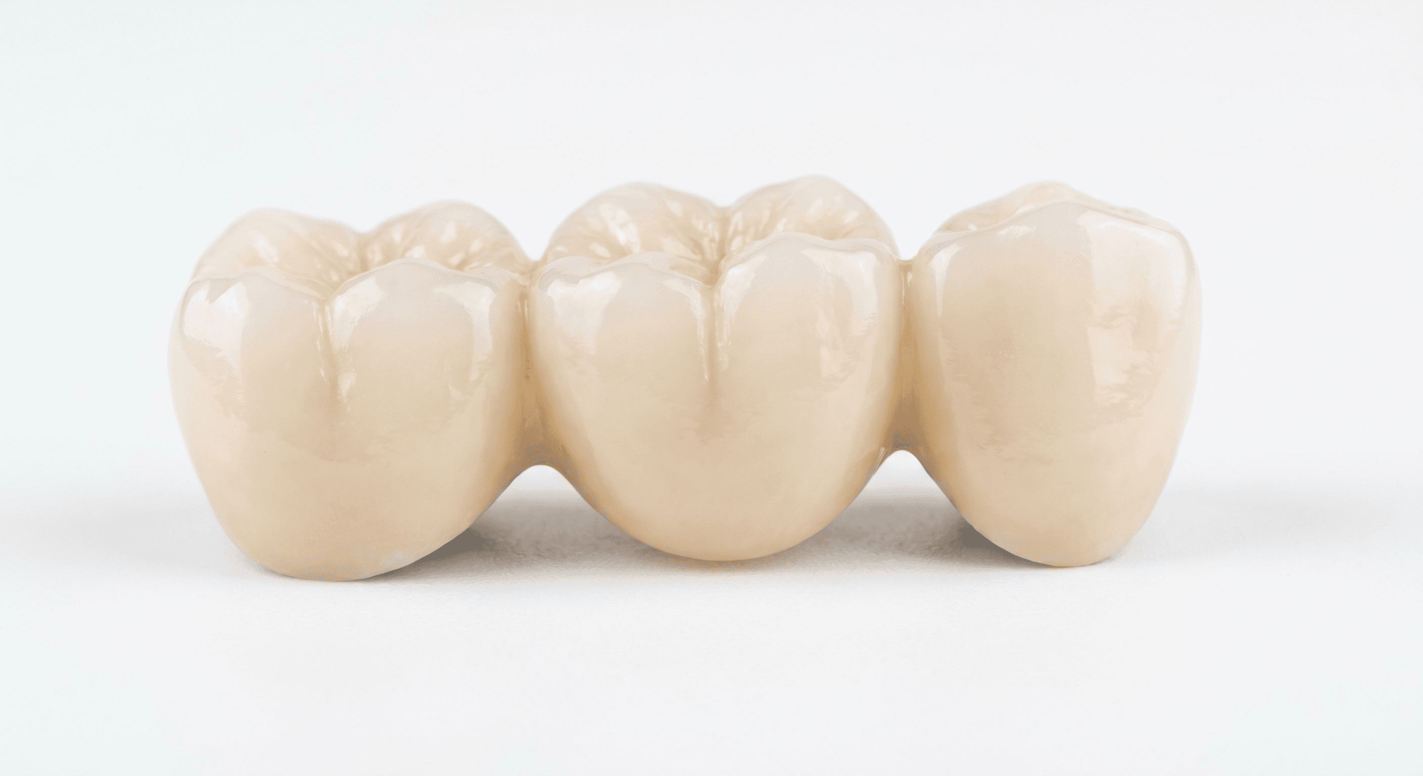 Dental Bridges: A Complete Guide to Replacing Missing Teeth