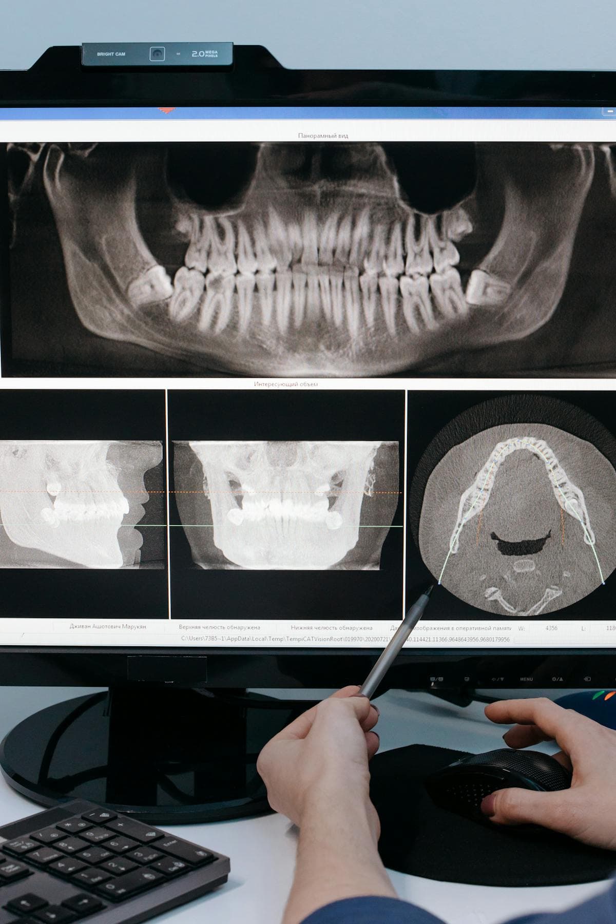 All-on-X Full Arch Implants: What You Need to Know