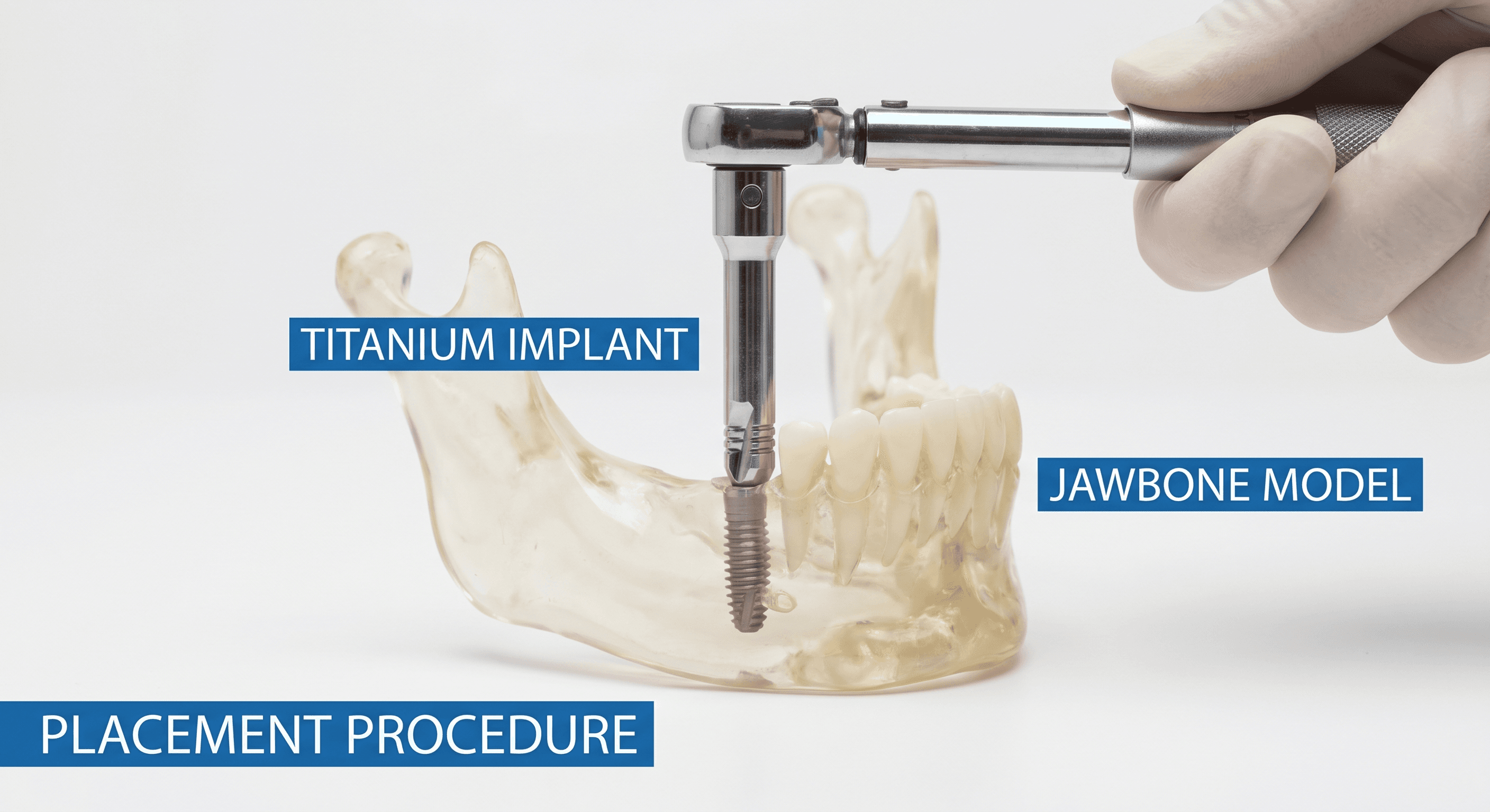 Do Dental Implants Hurt? An Honest Answer